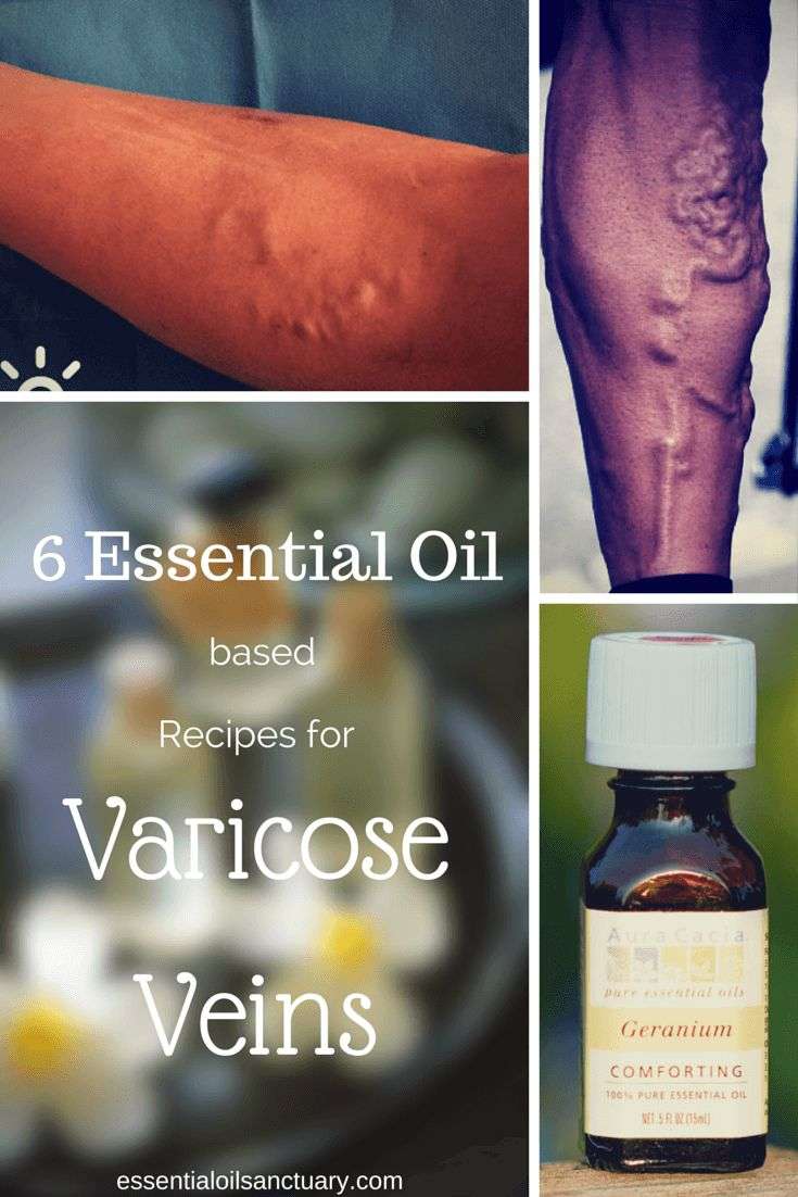 6 Essential Oil Based Remedies for Varicose Veins ...