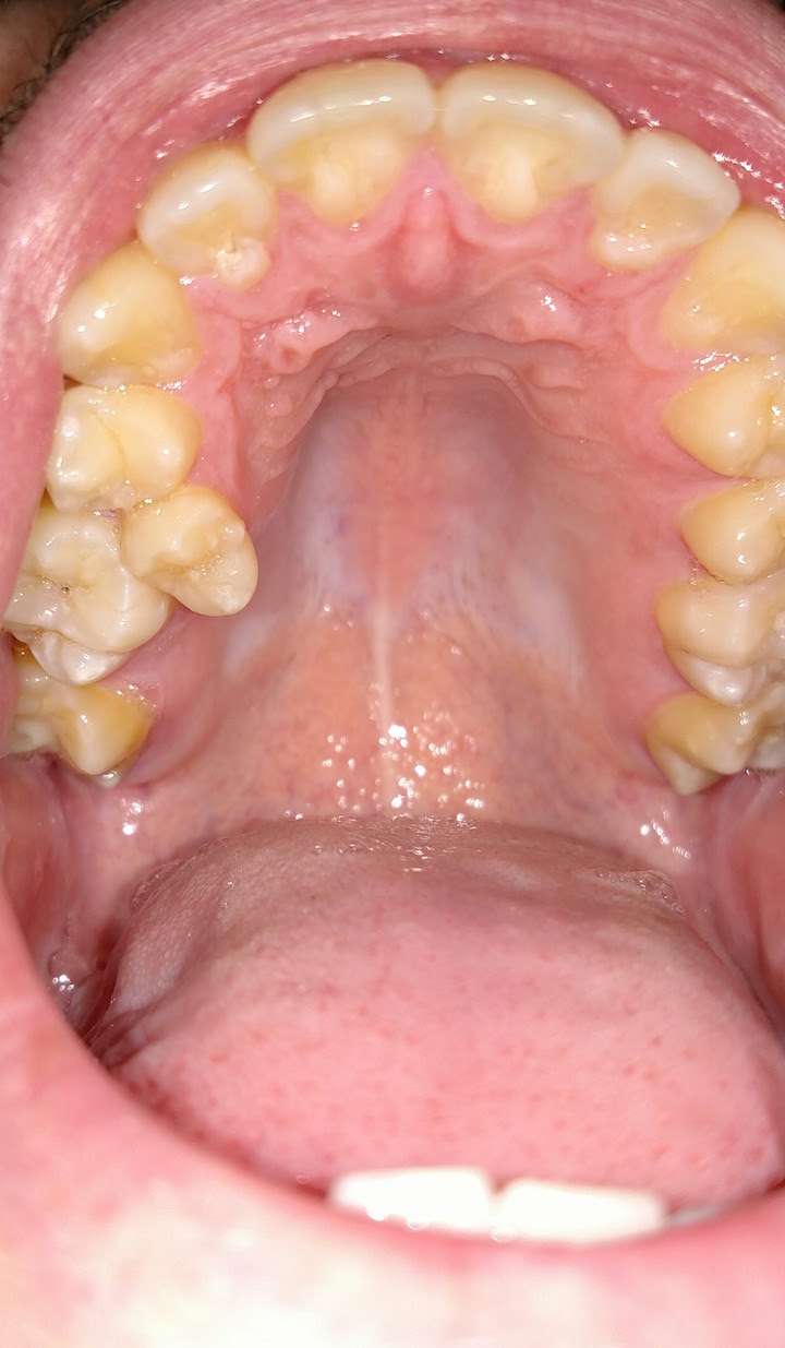 Foods To Eat After Wisdom Teeth Removal Reddit